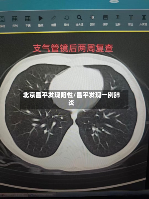 北京昌平发现阳性/昌平发现一例肺炎